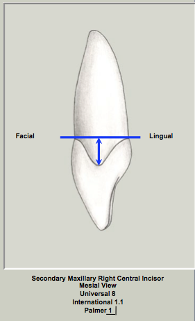 Ext Morph Mx Central Mesial 1.png